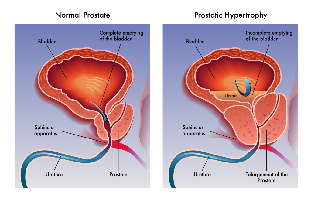 Prostatic hypertrophy 2.jpg